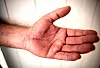 OPERERT: Karpaltunnelsyndrom kalles det.   Legen kaller det «skjærersyndrom». 