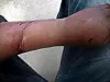 KLEMSKADE: Bildet er tatt på sykehuset noen timer etter at skaden skjedde.